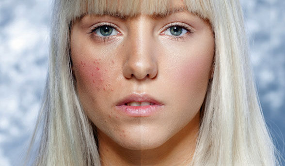 woman-with-pimples-on-one-cheek-_article_new_0